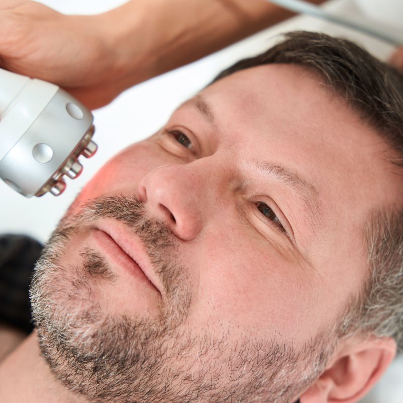 Hombre recibiendo un tratamiento de radiofrecuencia facial.