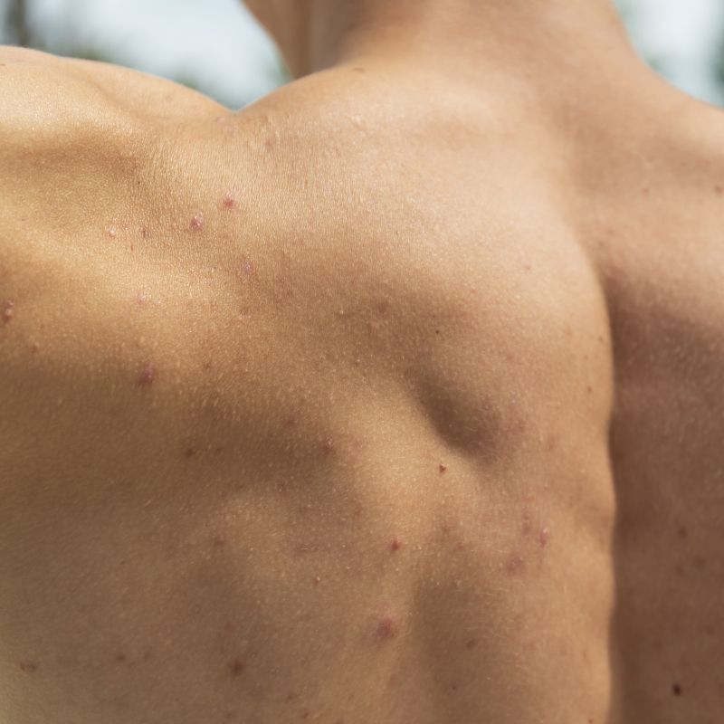 Primer plano de una espalda masculina con granitos.